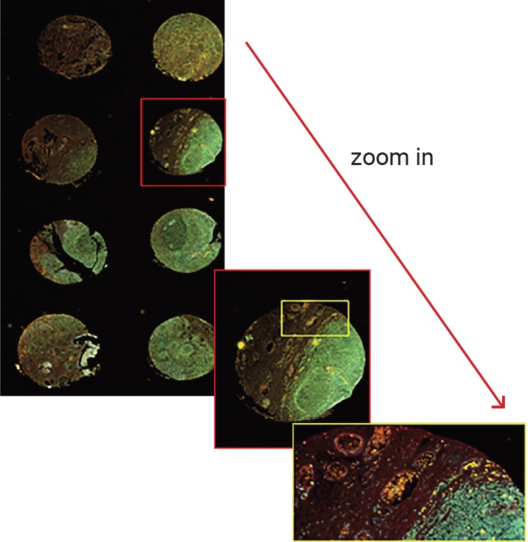 Tissue Immunofluorescence 2 Tissue Microarray scanned at 0.5μm pixel size. Automatic focusing is done for each of the TMA cores thanks to a highly precise algorithm.