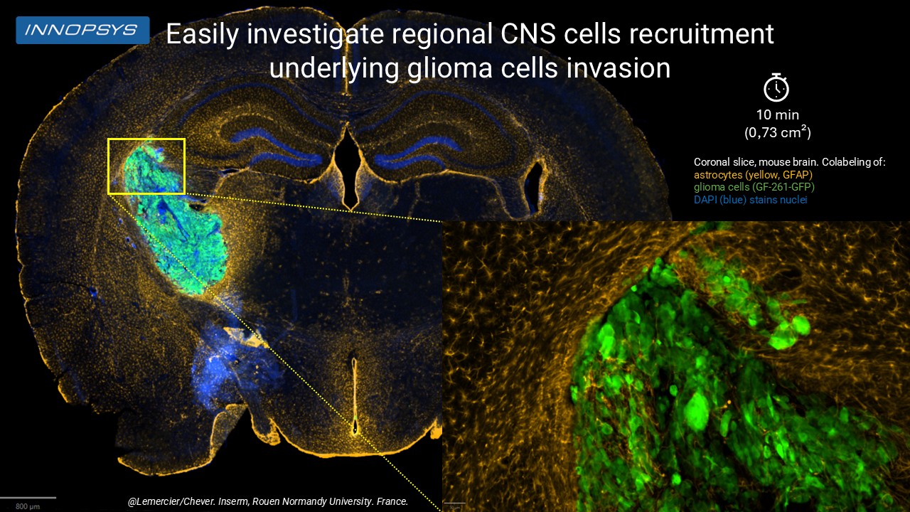 Glioma Cell Invasion Oana