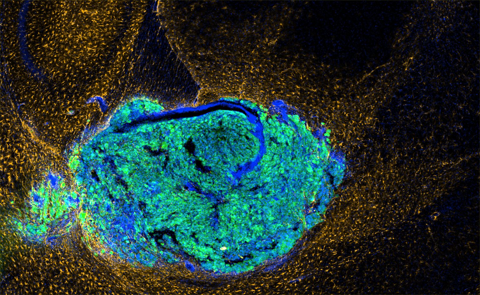Glioblastoma