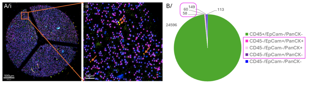 Figure 4: A/i/ Example of Patient sample filter with CTC and CAC defined with their DAPI (blue), EpCAM (green) and PanCK (yellow) staining while WBC are identified by their DAPI (blue) and CD45 (red) staining; ii/ zoom-in area with cells of interested pointed with orange arrows; B/ Repartition of pre-classified cells