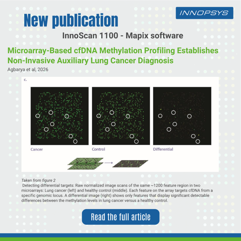 Microarray-Based cfDNA Methylation Profiling Establishes Non-Invasive Auxiliary Lung Cancer Diagnosis