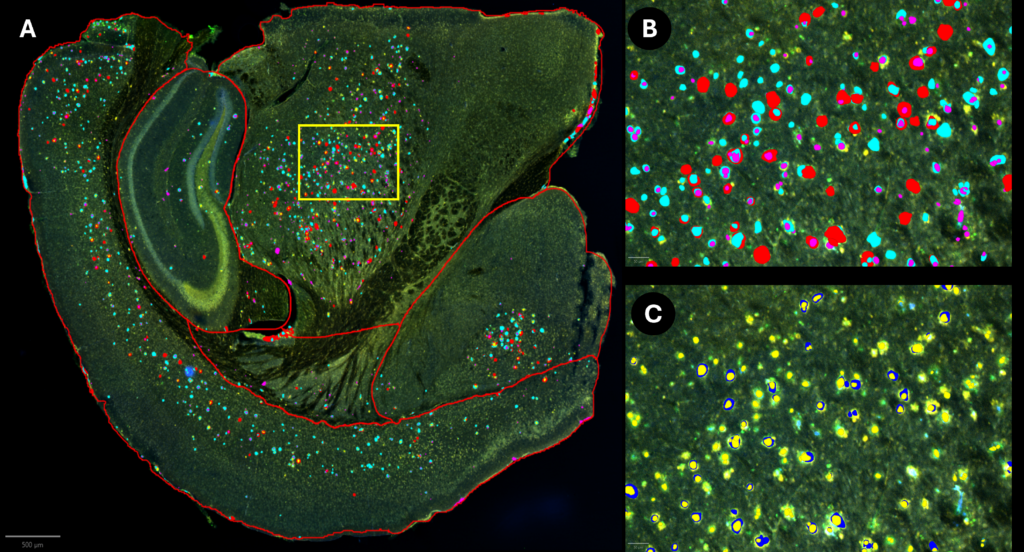 Alzheimer's disease amyloid beta plaques